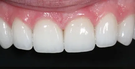 Patient's teeth after smile makeover at Libert Lake Smile Source.