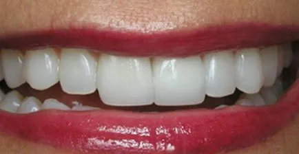 Patient's teeth after smile makeover at Libert Lake Smile Source.